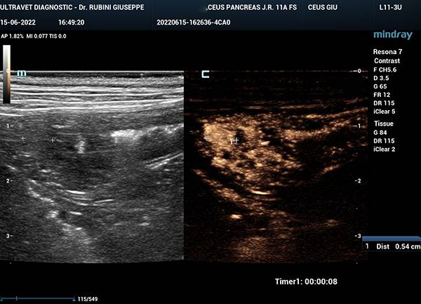 insulinoma-pancreas-diagnosi-clinica-citologica-ed-istologica-post-chirurgia