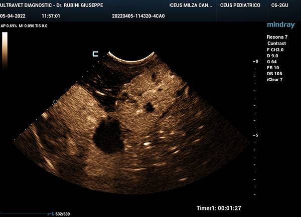 metastsi-epatiche-da-emangiosarcoma-splenico-non-visibili-allecografia-base-diagnosi-citologica